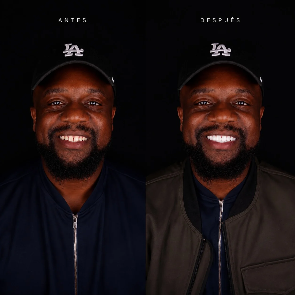 African American patient before/after porcelain veneers